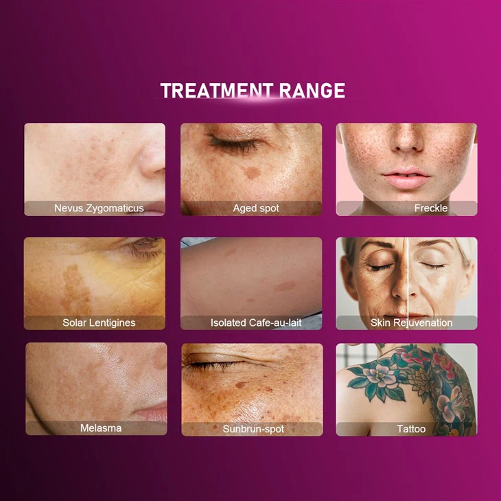 Pico Laser For Tattoo Removal Equipment