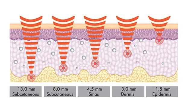 HIFU fat reduction HIFU fat reduction